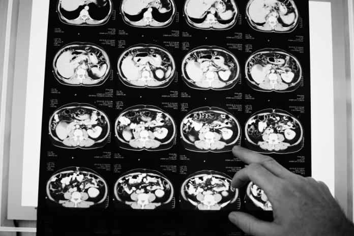Caixa de medicamento ao lado de laudo sobre câncer colorretal metastático